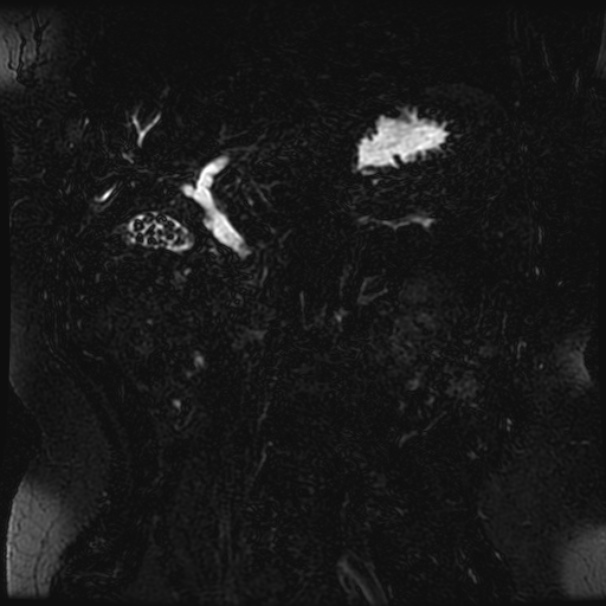 Choledocholithiasis on CT and MRI (Radiopaedia 24825-25088 Coronal T2 40).jpg