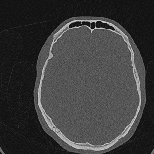 Cholesteatoma (Radiopaedia 70429-80529 Axial bone window 143).jpg