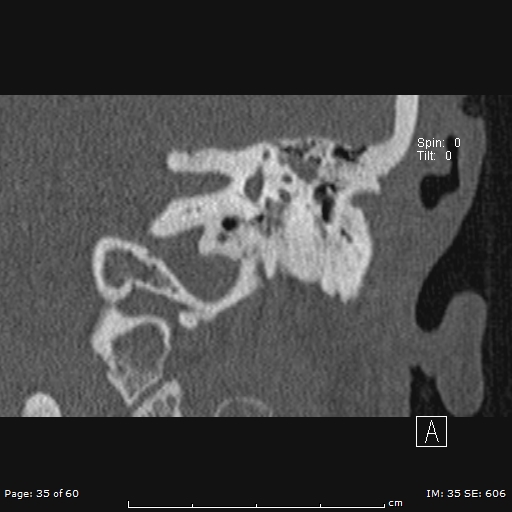 Cholesteatoma - external auditory canal (Radiopaedia 88452-105096 Coronal bone window 35).jpg