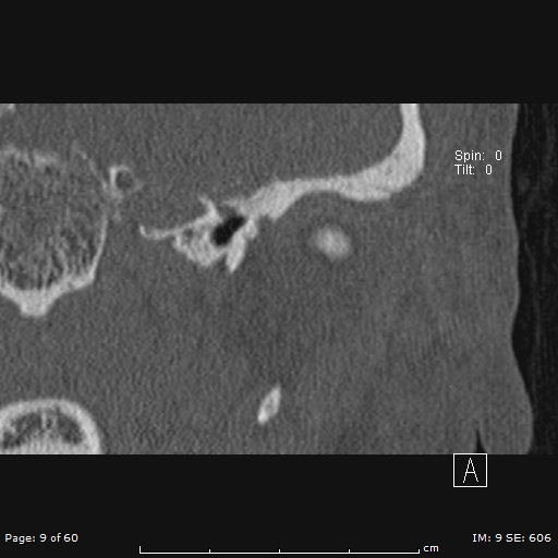 Cholesteatoma - external auditory canal (Radiopaedia 88452-105096 Coronal bone window 9).jpg