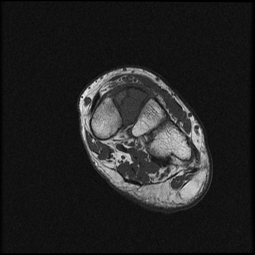 File:Chondroblastoma - midfoot (Radiopaedia 64831-73765 Short axis T1 13).jpg