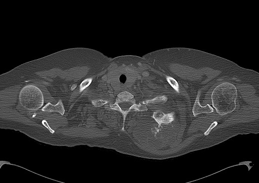 Chondrosarcoma - chest wall (Radiopaedia 65192-74199 Axial bone window 11).jpg