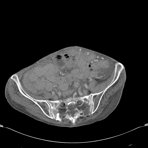 Chondrosarcoma of the spine (Radiopaedia 49871-55143 A 47).jpg