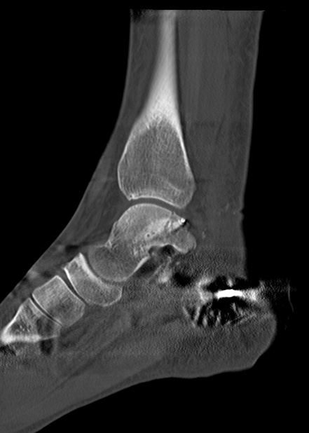 Chopart fracture (Radiopaedia 35347-36861 Sagittal bone window 36).jpg