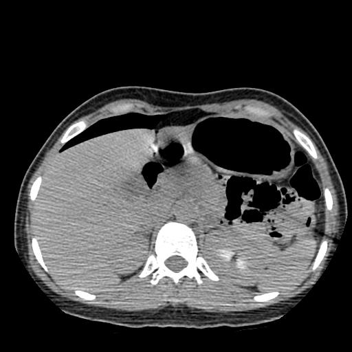 File:Choriocarcinoma of ovary with cerebral and pulmonary metastases (Radiopaedia 25983-26119 Axial non-contrast 92).jpg