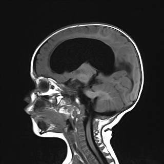 File:Choroid plexus papilloma (Radiopaedia 84612-100019 Sagittal T1 14).jpg