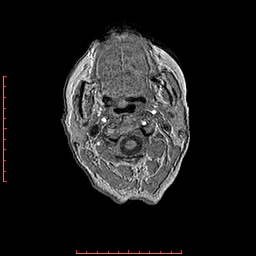 Choroid plexus xanthogranuloma (Radiopaedia 67843-77270 Axial T1 172).jpg