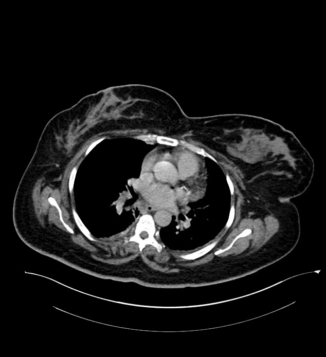 Chromophobe renal cell carcinoma (Radiopaedia 84239-99519 E 5).jpg
