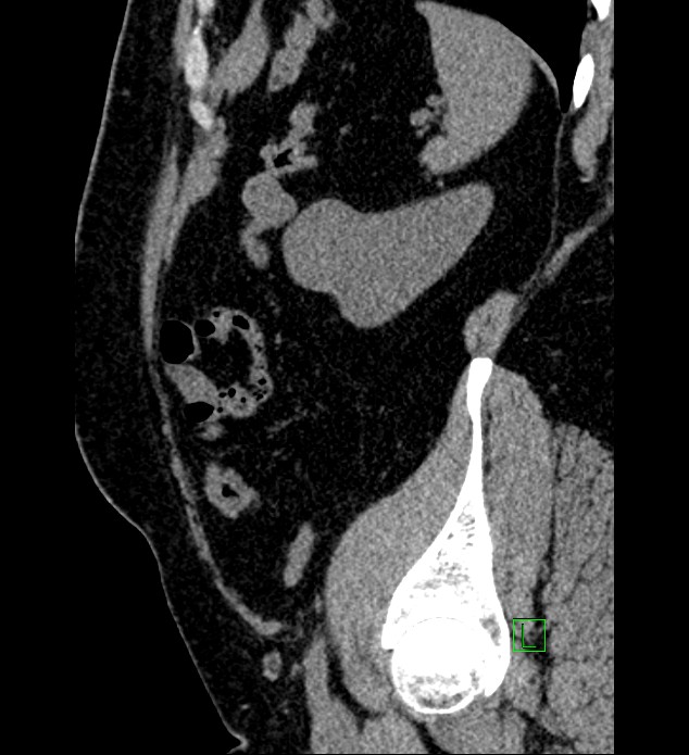 Chromophobe renal cell carcinoma (Radiopaedia 84286-99573 C 35).jpg