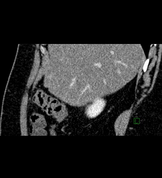 Chromophobe renal cell carcinoma (Radiopaedia 84286-99573 F 140).jpg