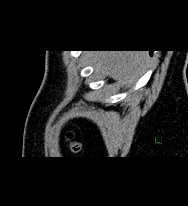 Chromophobe renal cell carcinoma (Radiopaedia 84286-99573 F 170).jpg
