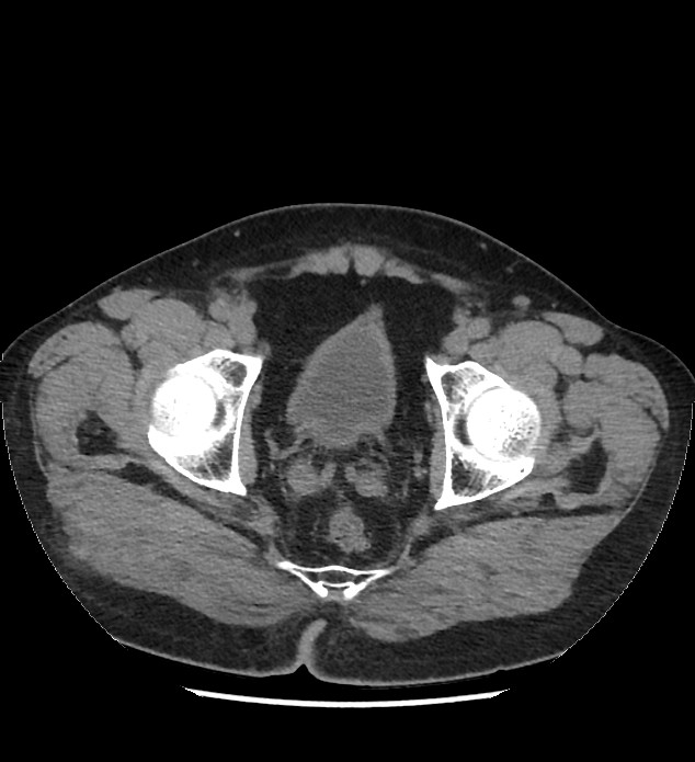 Chromophobe renal cell carcinoma (Radiopaedia 86879-103083 Axial non-contrast 121).jpg