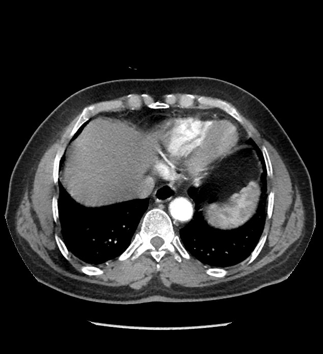 Chromophobe renal cell carcinoma (Radiopaedia 86879-103083 B 14).jpg