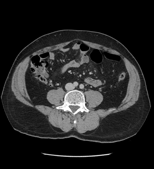 Chromophobe renal cell carcinoma (Radiopaedia 86879-103083 C 90).jpg