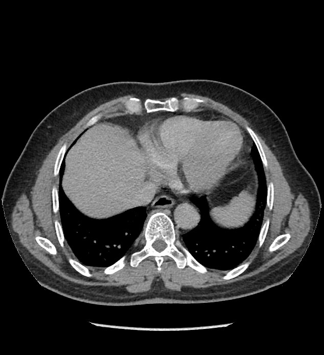 Chromophobe renal cell carcinoma (Radiopaedia 86879-103083 D 6).jpg