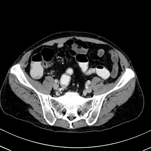 Chronic appendicitis complicated by appendicular abscess, pylephlebitis and liver abscess (Radiopaedia 54483-60700 B 111).jpg