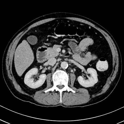 Chronic appendicitis complicated by appendicular abscess, pylephlebitis and liver abscess (Radiopaedia 54483-60700 B 65).jpg