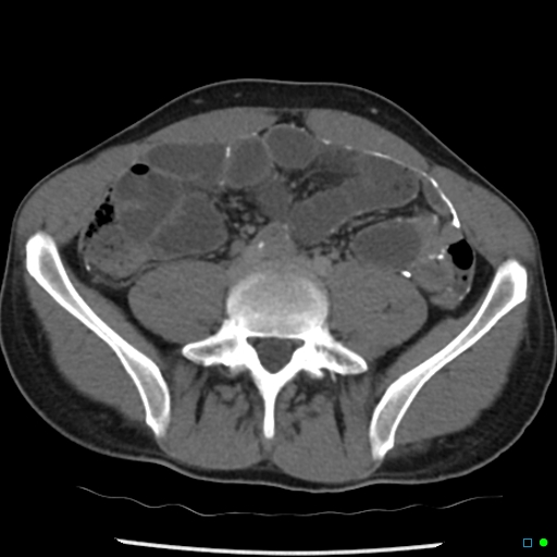 File:Chronic barium peritonitis and small bowel obstruction (Radiopaedia 29151-29548 D 10).jpg