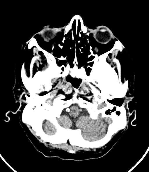 File:Chronic bilateral subdural hygroma (Radiopaedia 85801-101623 Axial non-contrast 51).jpg