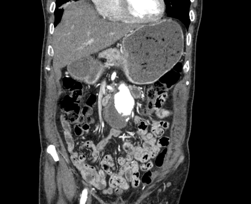 File:Chronic contained rupture of abdominal aortic aneurysm with extensive erosion of the vertebral bodies (Radiopaedia 55450-61901 D 13).jpg
