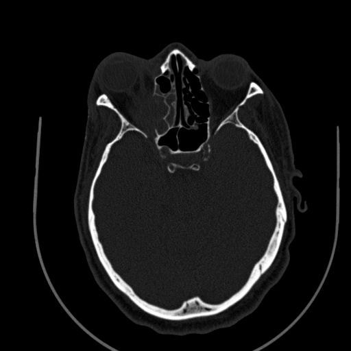 Chronic invasive fungal sinusitis (Radiopaedia 91563-109286 Axial sinus 84).jpg