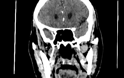 Chronic invasive fungal sinusitis (Radiopaedia 91563-109286 D 82).jpg