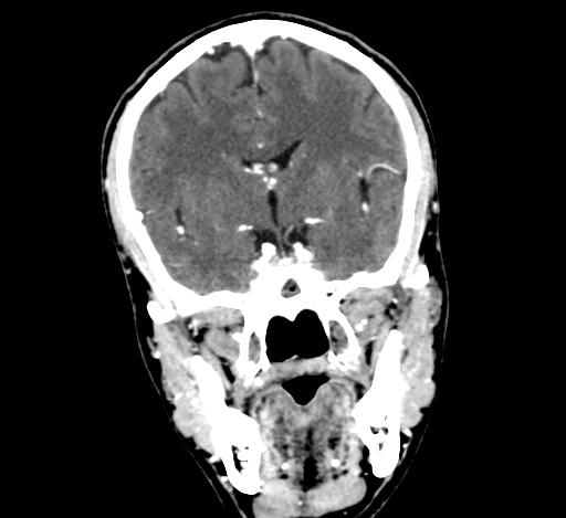 Chronic invasive fungal sinusitis with intraorbital and intracranial extension (Radiopaedia 56387-63046 C 183).jpg