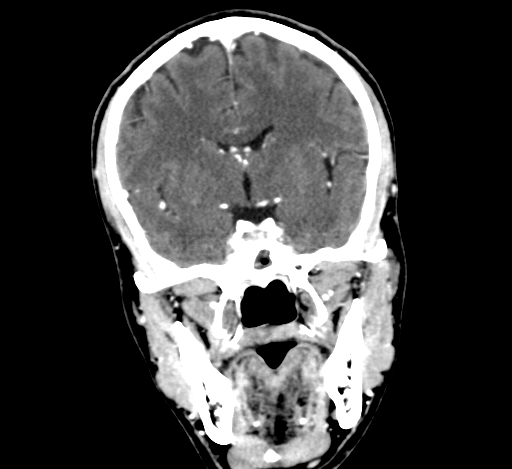Chronic invasive fungal sinusitis with intraorbital and intracranial extension (Radiopaedia 56387-63046 C 186).jpg