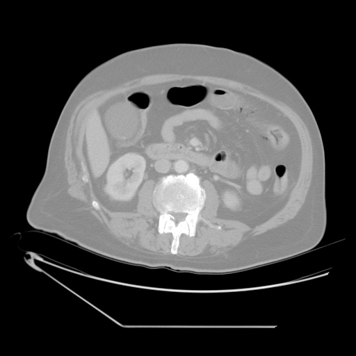 File:Chronic mesenteric ischemia - arterial (Radiopaedia 88205-104810 Axial lung window 12).jpg