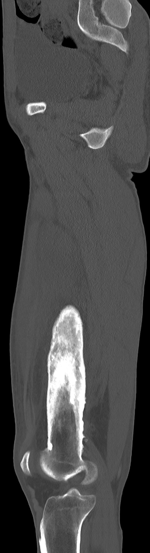 Chronic osteomyelitis (with sequestrum) (Radiopaedia 74813-85822 C 70).jpg