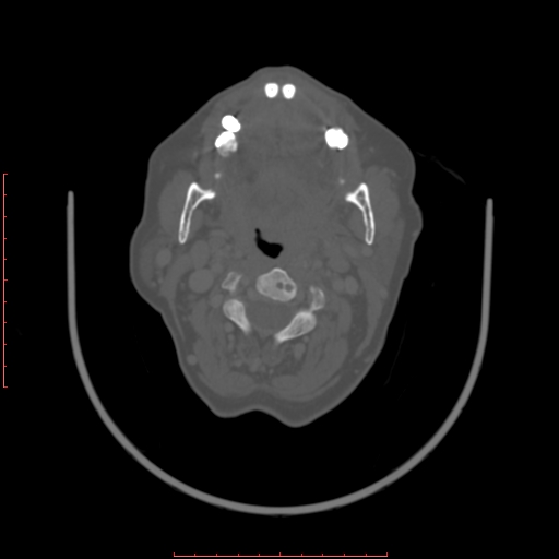 Chronic osteomyelitis - maxilla (Radiopaedia 23783-23927 Axial bone window 54).jpg