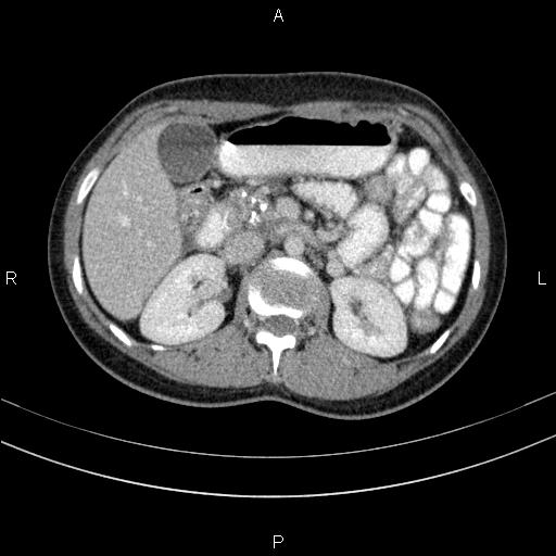 File:Chronic pancreatitis (Radiopaedia 64576-73450 C 59).jpg