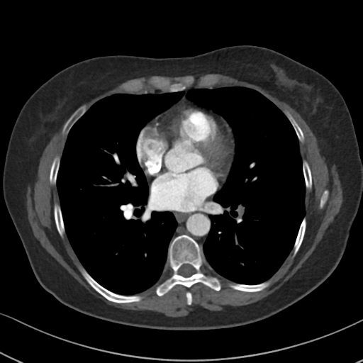Chronic pulmonary embolus (Radiopaedia 39129-41341 Axial C+ CTPA 60).png