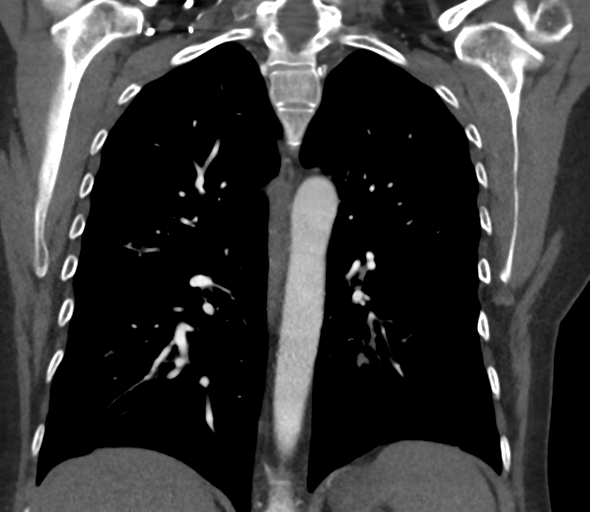 File:Chronic pulmonary embolus (Radiopaedia 39129-41341 Coronal C+ CTPA 55).png