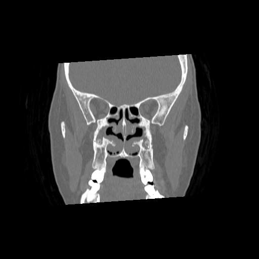 File:Chronic sinusitis with intra-sinus calcification (Radiopaedia 63919-72668 Coronal bone window 15).jpg