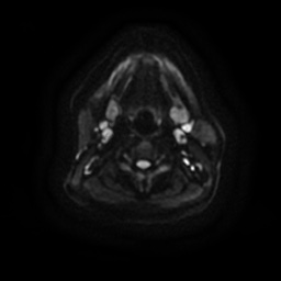 Chronic submandibular sialadenitis (Radiopaedia 61852-69885 Axial DWI 14).jpg