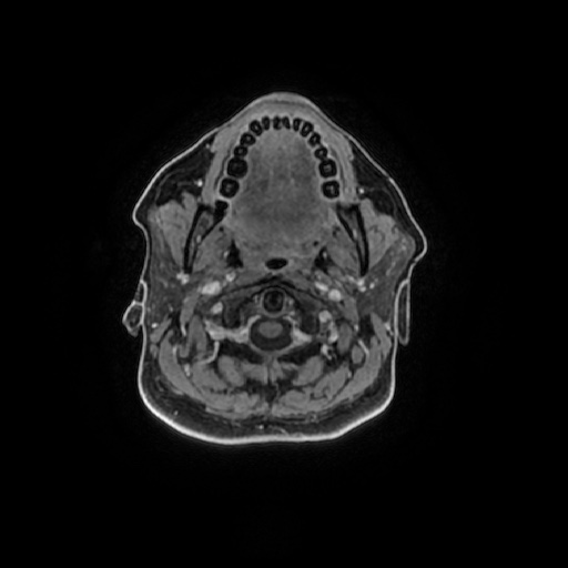 Chronic submandibular sialadenitis (Radiopaedia 61852-69885 Axial T1 C+ fat sat 84).jpg