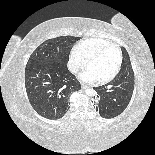 Cicatrisation collapse (Radiopaedia 17405-17089 lung window 72).jpg