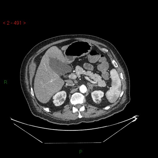 Circumaortic left renal vein and doubled left renal arteries (Radiopaedia 52268-58158 A 27).jpg