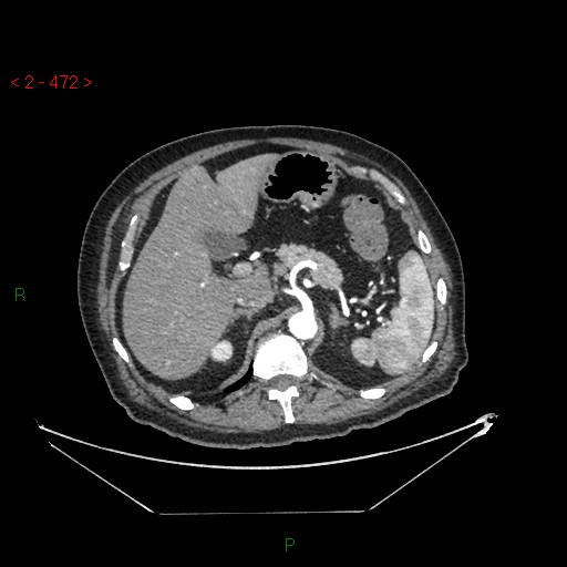 File:Circumaortic left renal vein and doubled left renal arteries (Radiopaedia 52268-58158 A 8).jpg