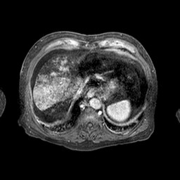 Cirrhosis and hepatocellular carcinoma in the setting of hemochromatosis (Radiopaedia 75394-86594 Axial T1 C+ fat sat 322).jpg