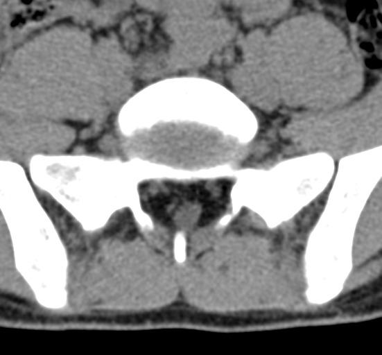 Clear cell meningoma - lumbar spine (Radiopaedia 60116-67691 Axial non-contrast 66).png