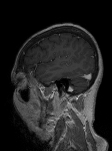 Clival meningioma (Radiopaedia 53278-59248 Sagittal T1 C+ 171).jpg