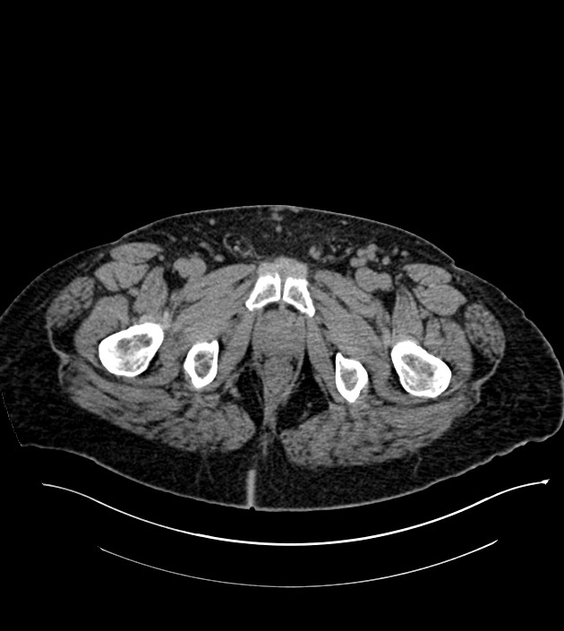 Closed-loop small bowel obstruction-internal hernia (Radiopaedia 78439-91096 Axial non-contrast 158).jpg