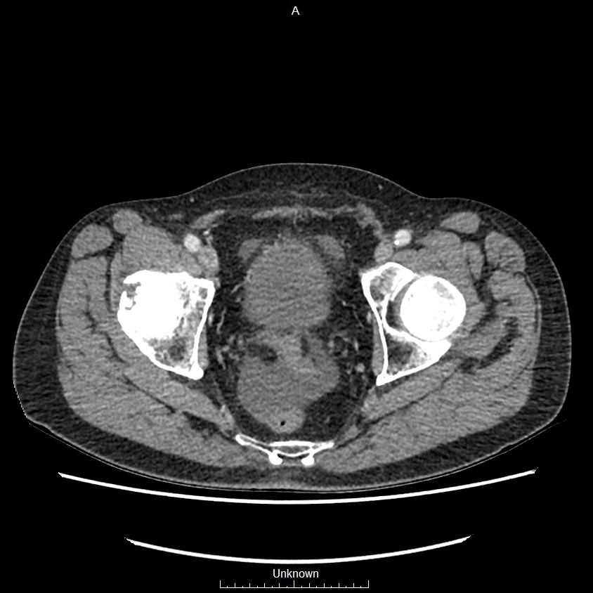 Closed loop bowel obstruction and ischemia (Radiopaedia 86959-103180 A 81).jpg