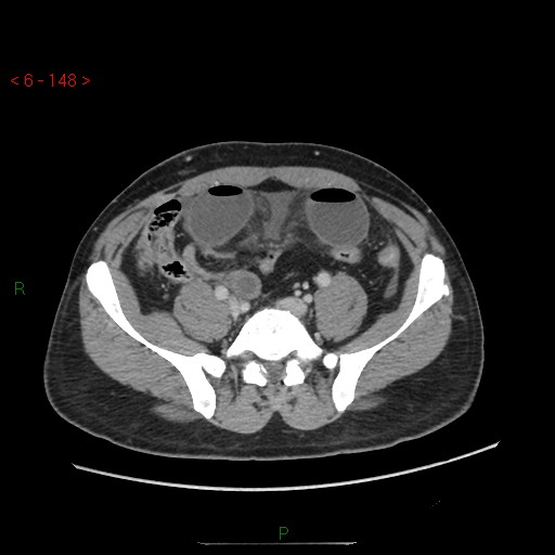 Closed loop obstruction and appendicular stump mucocele (Radiopaedia 54014-60163 A 87).jpg