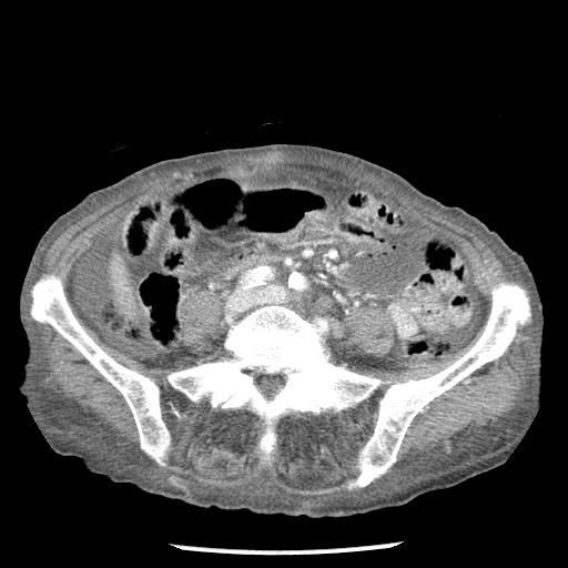 Closed loop small bowel obstruction - adhesions and infarct (Radiopaedia 85125-100678 B 61).jpg