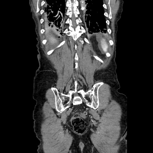 Closed loop small bowel obstruction - adhesive disease and hemorrhagic ischemia (Radiopaedia 86831-102990 B 108).jpg