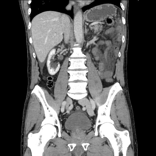 File:Closed loop small bowel obstruction - omental adhesion causing "internal hernia" (Radiopaedia 85129-100682 B 75).jpg