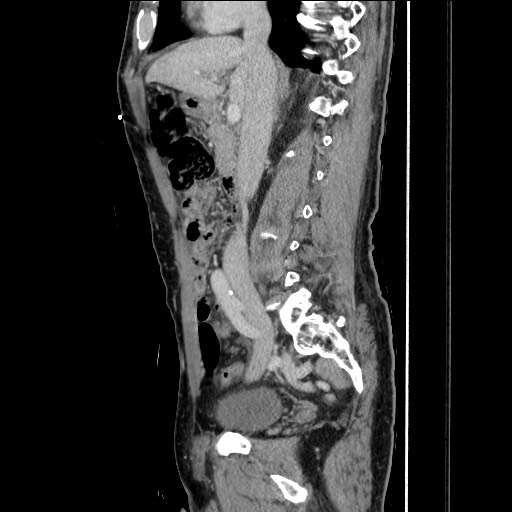 Closed loop small bowel obstruction - omental adhesion causing "internal hernia" (Radiopaedia 85129-100682 C 80).jpg